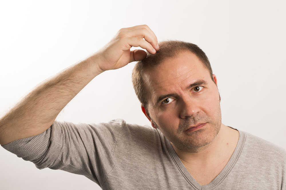 Symptoms and Treatments for Male Pattern Baldness